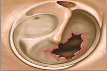 鼓膜穿孔是否構(gòu)成輕傷？